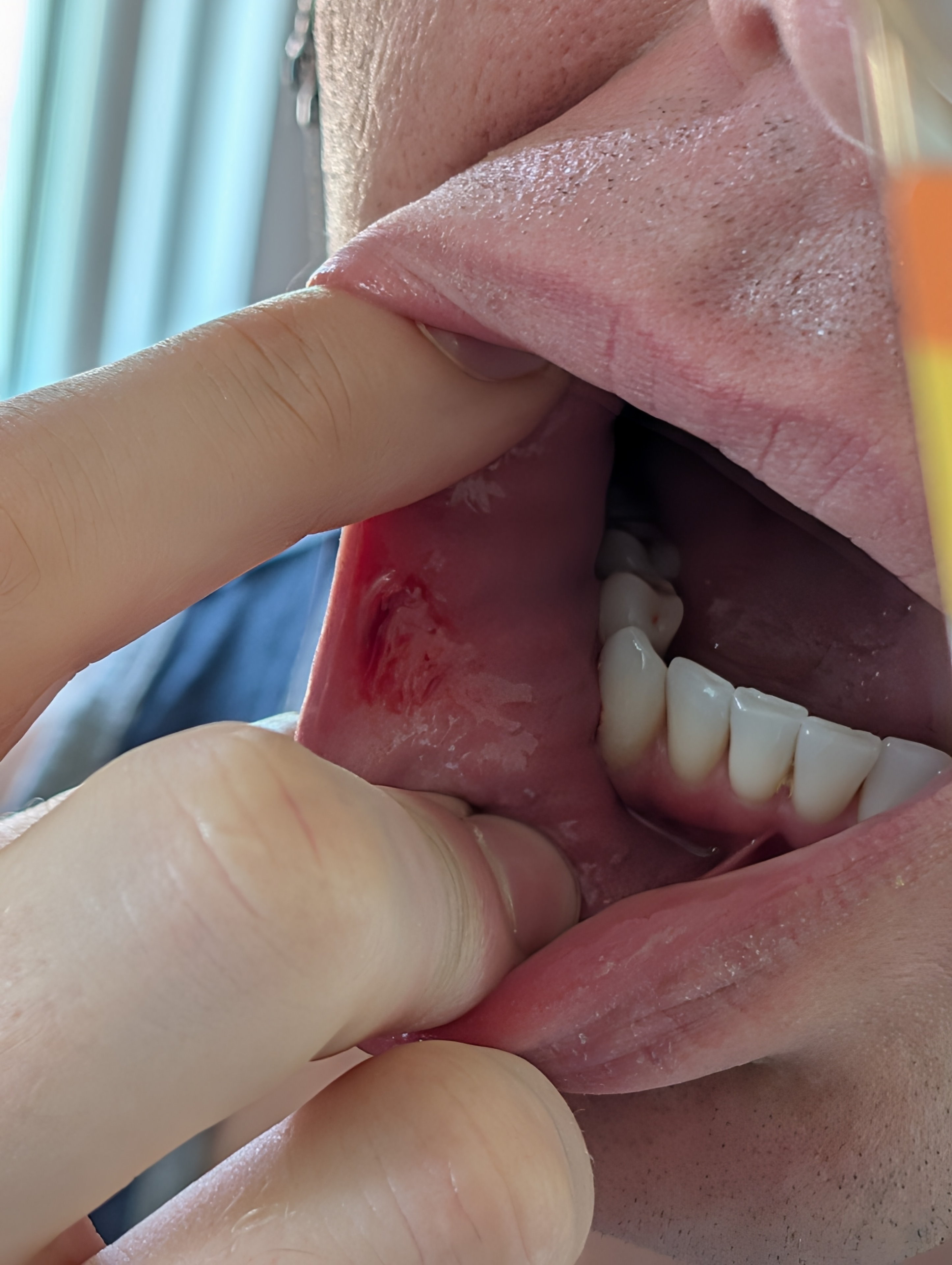 How did I bite such a big chunk out of my lip!?